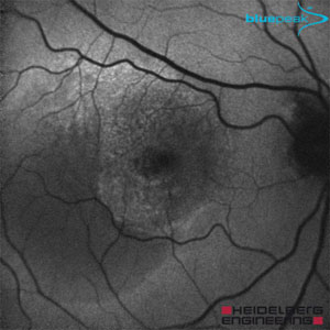 fundus amd feucht faf