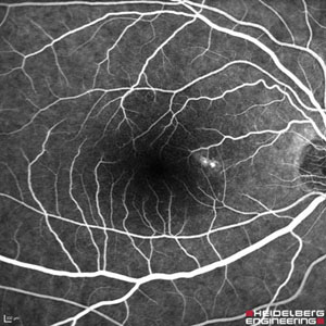 fundus fa cscr