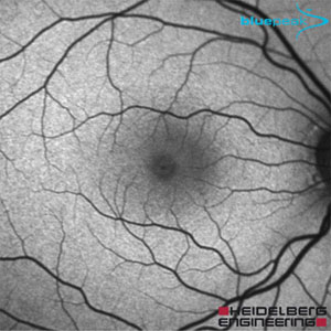 fundus normal faf